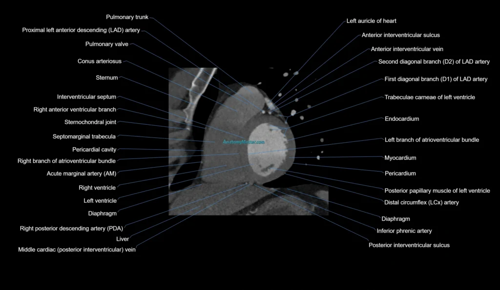 CT heart (coronary angiogram) short axis view cross sectional anatomy labelled radiology image
