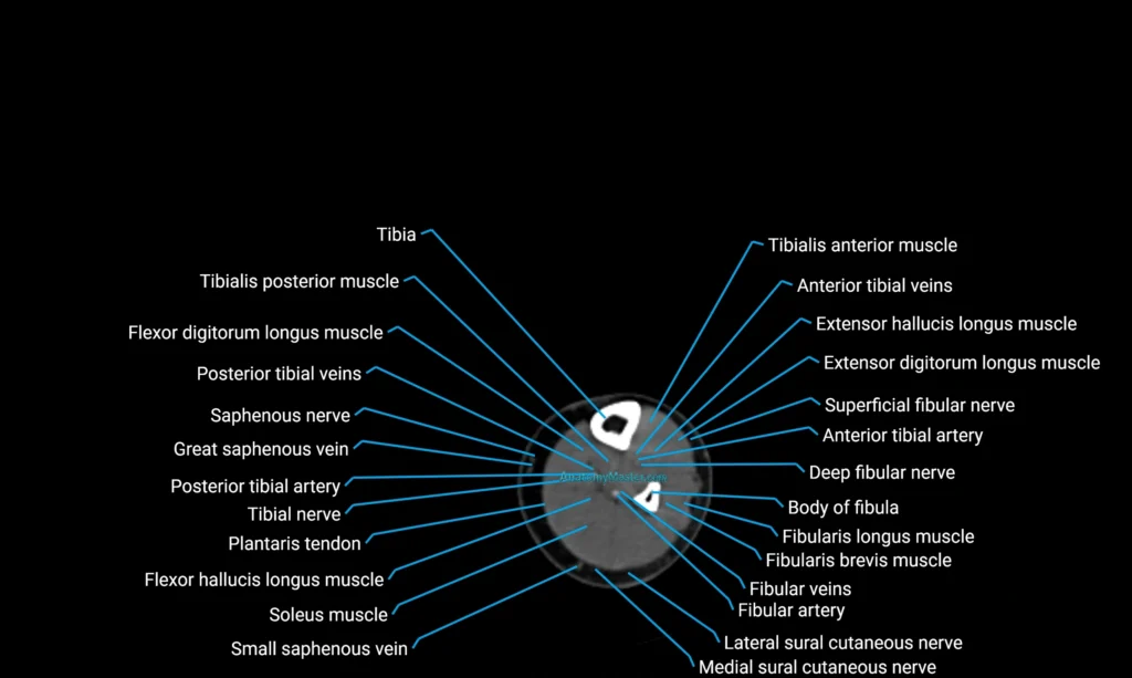CT lower limb axial cross sectional anatomy labelled image