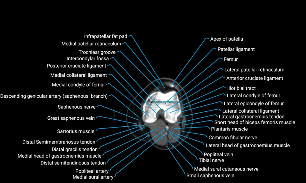CT lower limb axial cross sectional anatomy labelled image 87