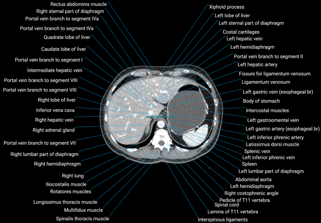 CT male pelvis axial cross sectional anatomy labelled radiology image
