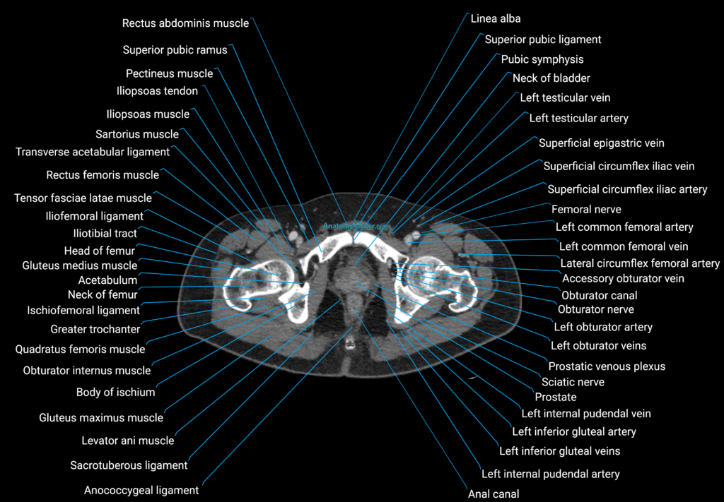 CT male pelvis axial cross sectional anatomy labelled radiology image