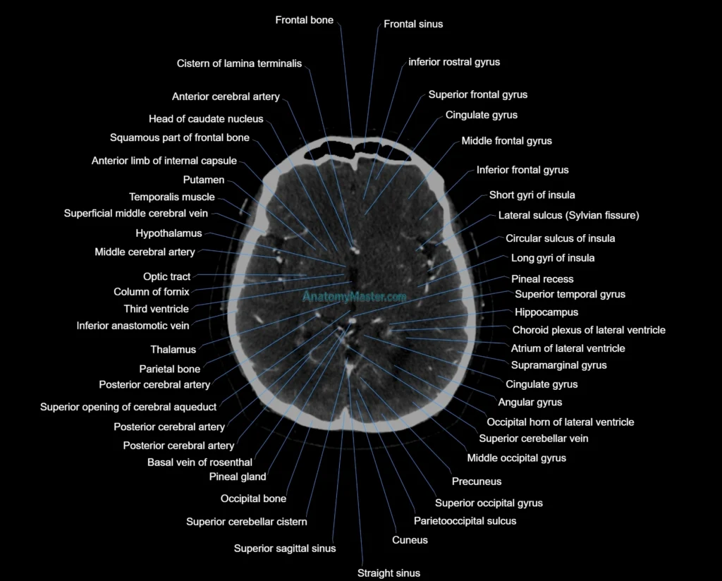 CT scan brain axial labelled cross sectional anatomy image