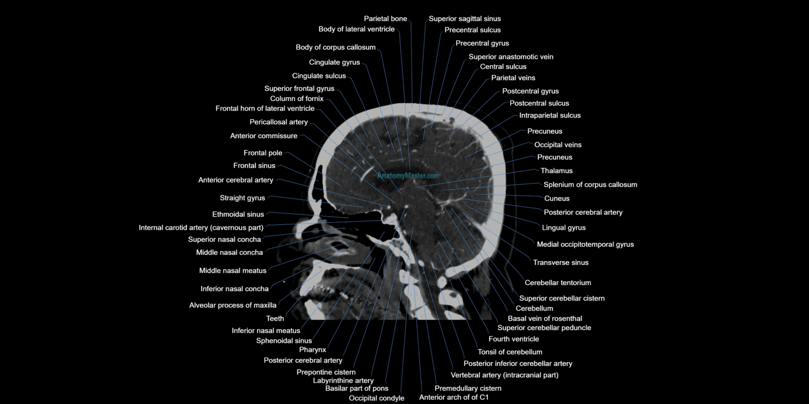 CT anatomy | Head and Brain CT Anatomy Atlas