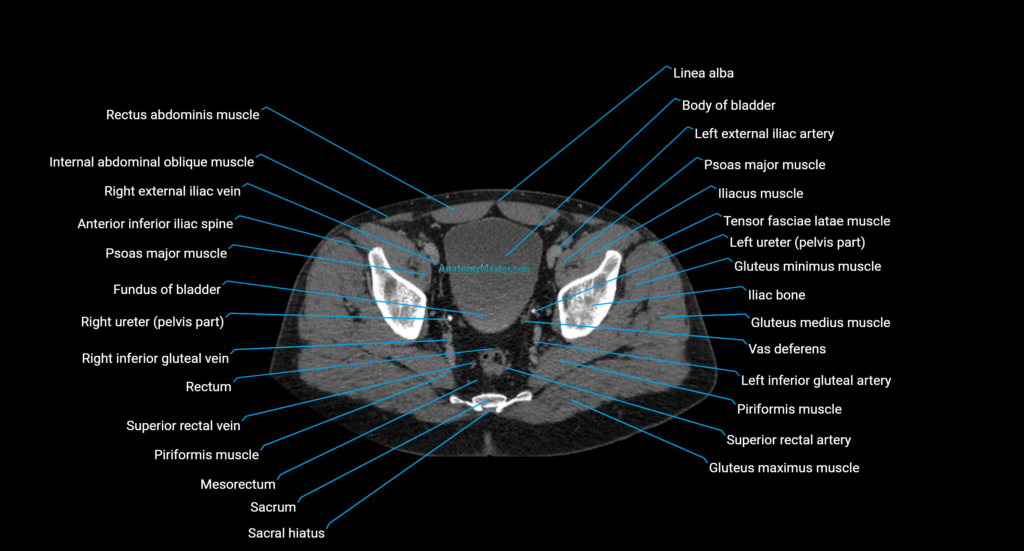 CT urogram axial axial cross sectional anatomy enchanced radiology image