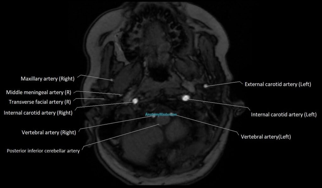 MRA Carotid artery anatomy axial 3T image