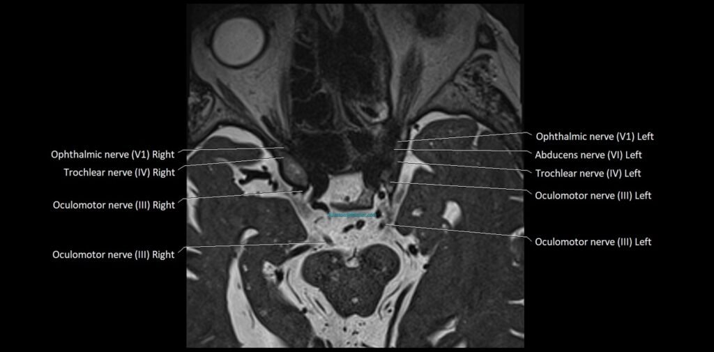 Cranial nerve anatomy axial MRI 3T image