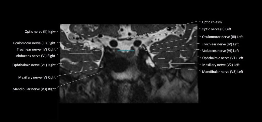 Cranial nerve cross sectional anatomy coronal 3T MRI image