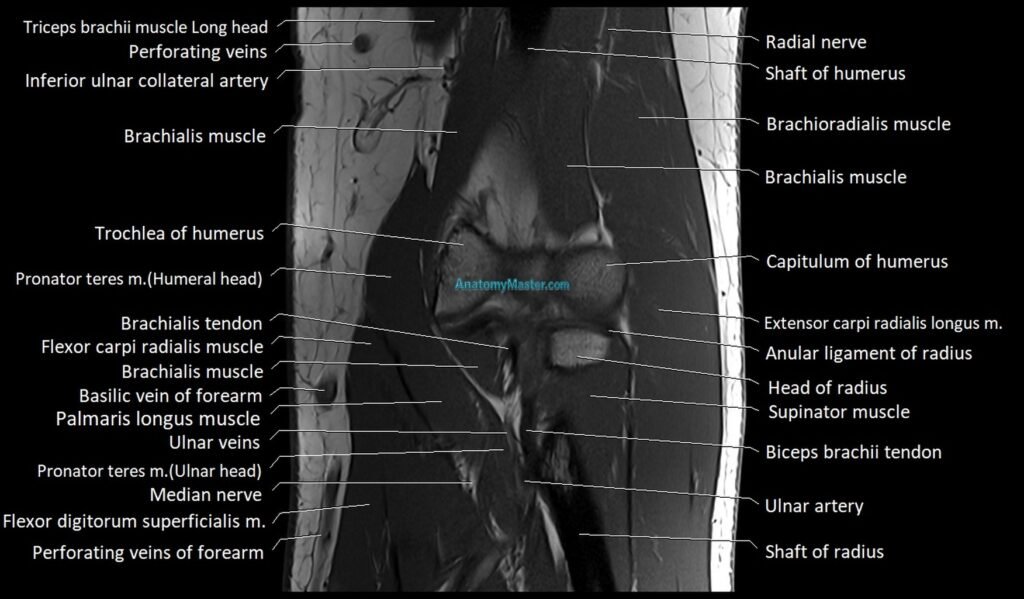 Elbow coronal anatomy image cross sectional 3T MRI image