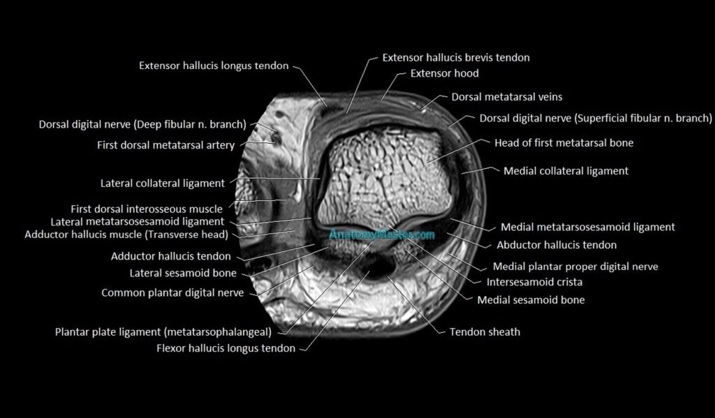 Great toe (hallux) axial microanatomy 3T MRI image