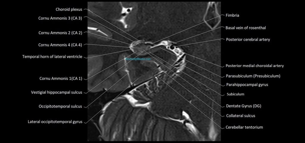 Hippocampus anatomy mri coronal cross section 3T MRI
