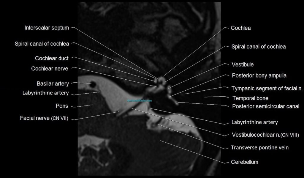 Internal auditory canal (IAC) axial cross sectional anatomy image