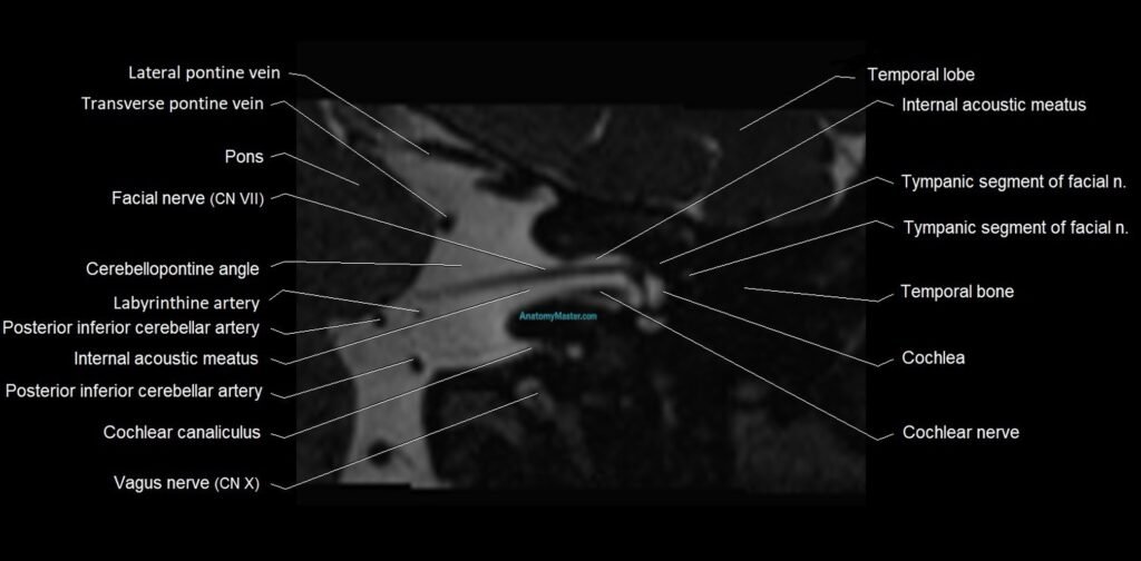 Internal auditory meatus (IAM) axial cross sectional anatomy image