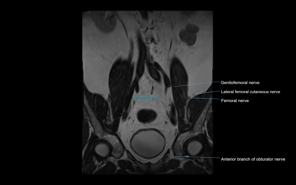 MR lumbosacral plexus cross sectional anatomy 3T radiology image