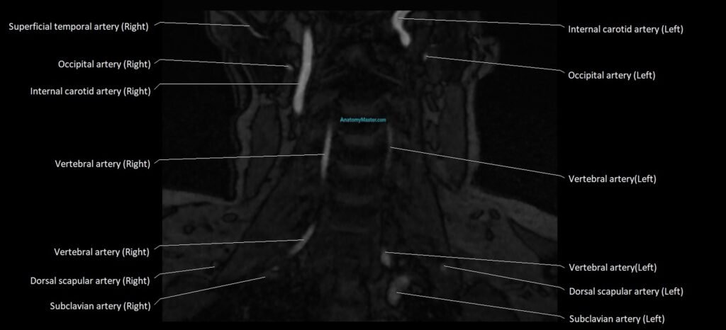 MRA carotid artery anatomy cross sectional 3T coronal image