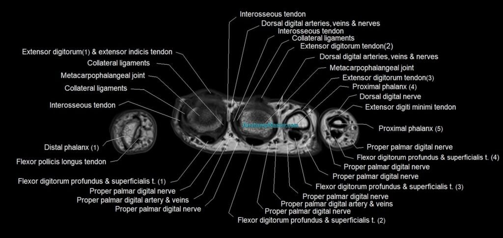 MRI 3T ax1al hand axial sectional anatomy image