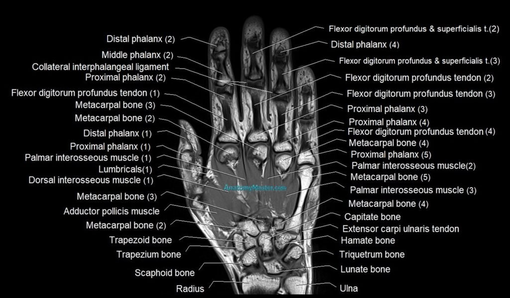 MRI 3T coronal hand cross sectional anatomy image