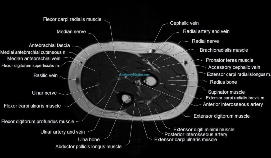 MRI 3T forearm axial cross sectional anatomy image