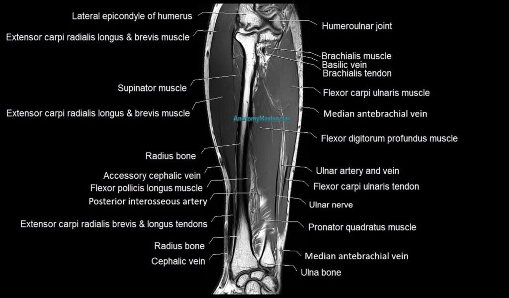 MRI 3T forearm coronal cross sectional anatomy image