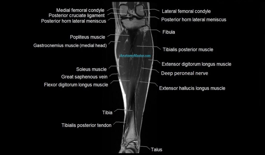 MRI 3T leg coronal cross sectional anatomy image