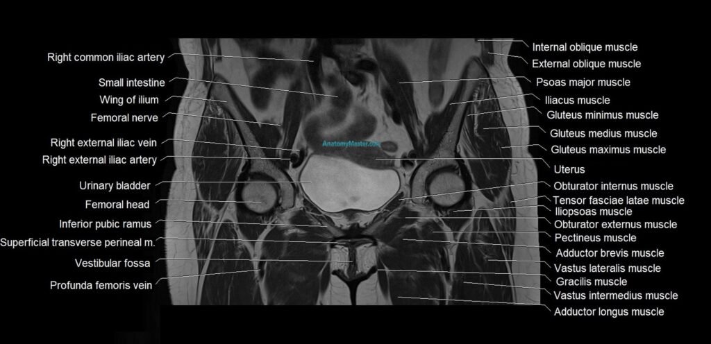 MRI 3T pelvis coronal cross section anatomy image