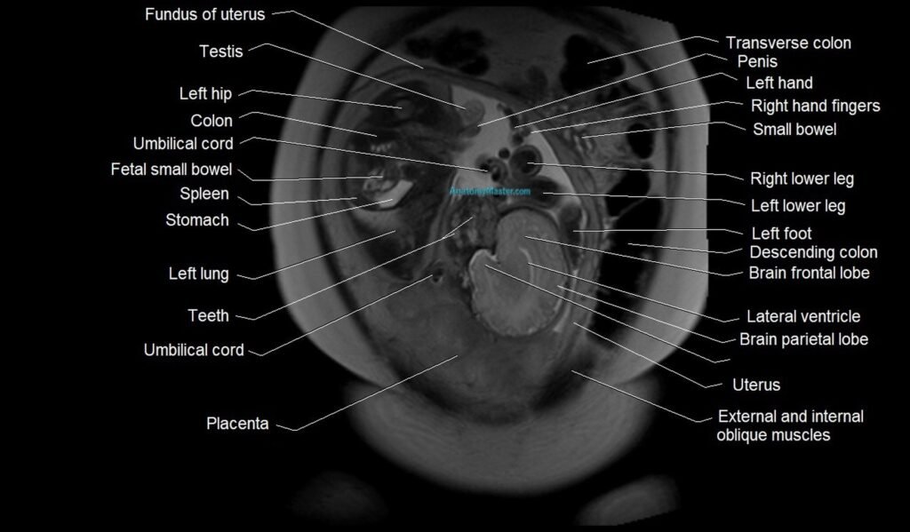 MRI Anatomy of pregnancy image