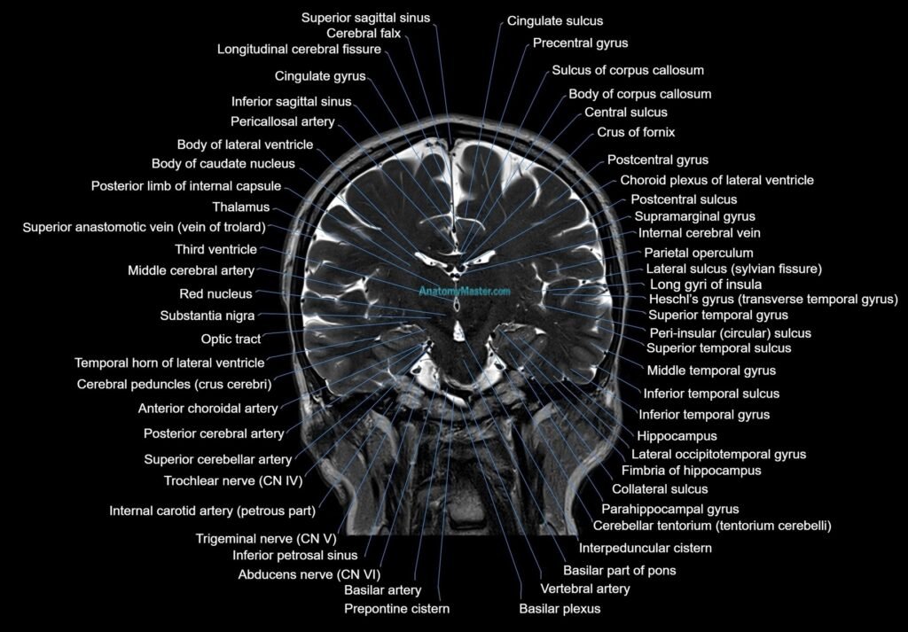 MRI Brain coronal cross sectional labelled anatomy 3T image