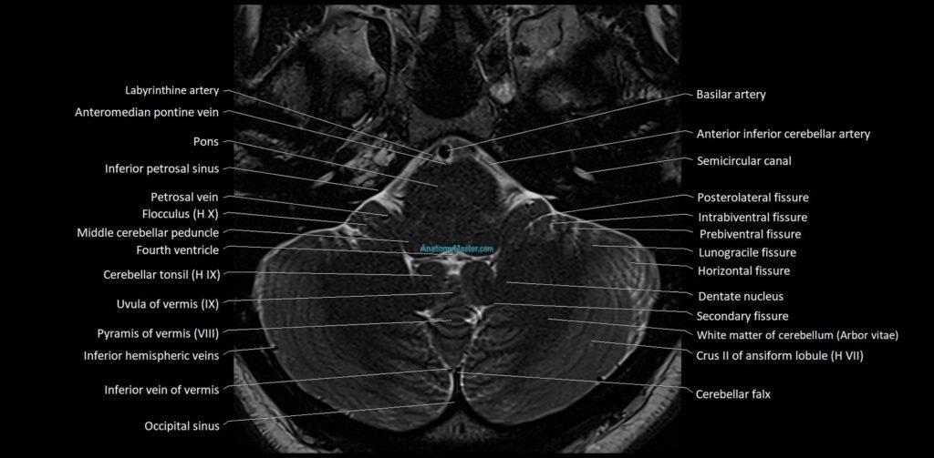 MRI Cerebellar anatomy High-resolution labelled 3T MRI image
