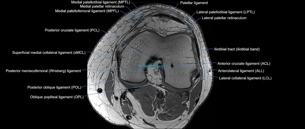 MRI Knee axial ligaments cross sectional anatomy 3T radiology image