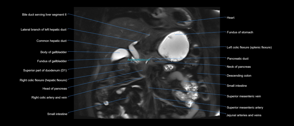 MRI MRCP coronal cross sectional 3T radiology image