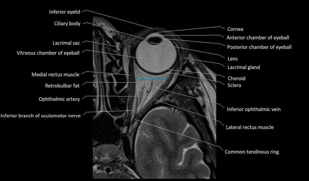 MRI Orbit axial cross sectional anatomy image
