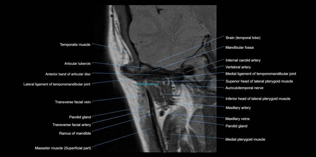 MRI TMJ coronal cross sectional 3T anatomy