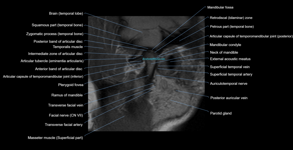 MRI TMJ sagittalclosed mouth cross sectional 3T anatomy