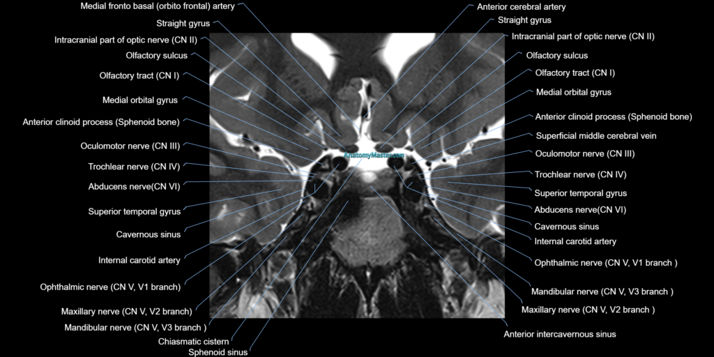 MRI cavernous sinus coronal cross sectional 3T anatomy image