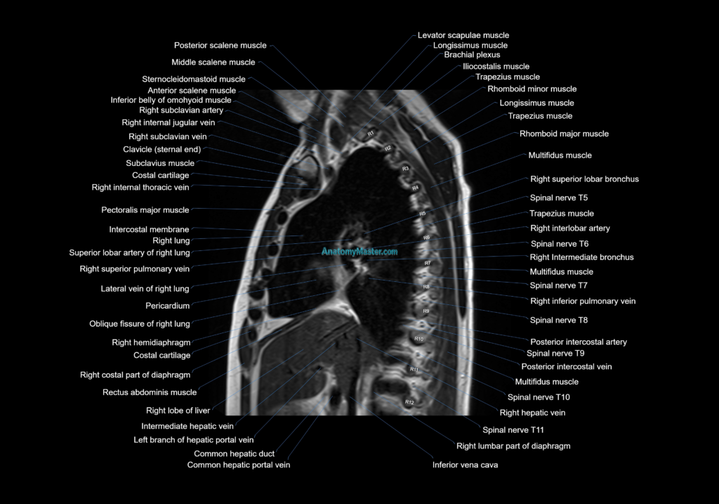 MRI chest (thorax) coronal cross sectional anatomy 3T radiology image