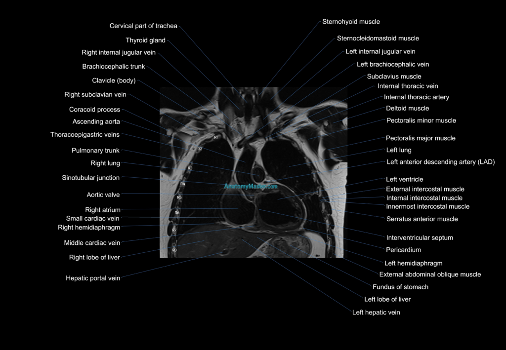 MRI chest (thorax) coronal cross sectional anatomy 3T radiology image