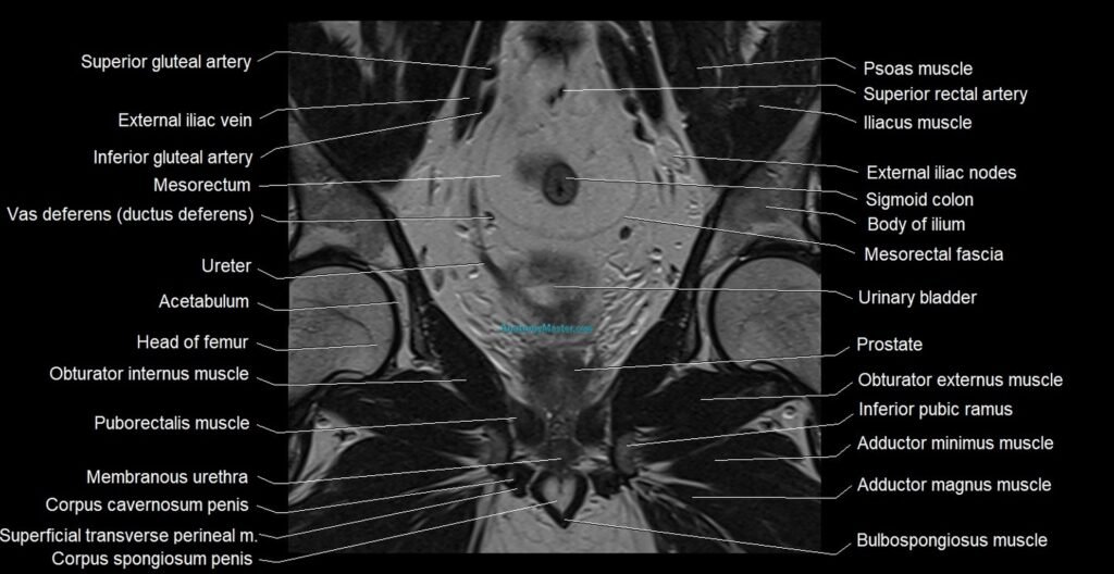 MRI coronal cross sectional anatomy male pelvis image
