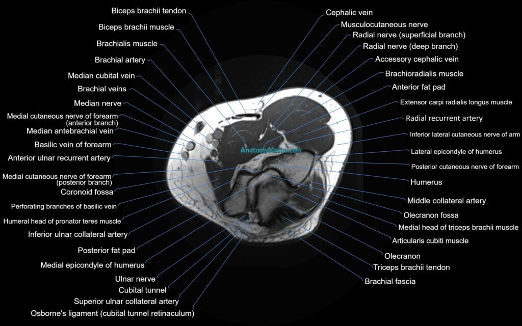 MRI elbow axial cross sectional anatomy 3T radiology image