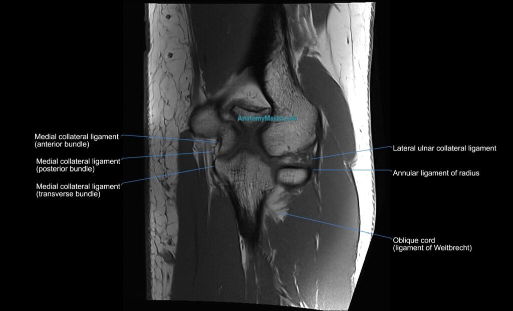 MRI elbow ligaments coronal cross sectional anatomy 3T radiology image