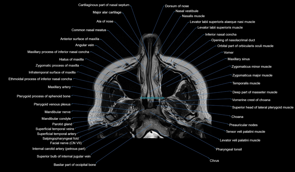 MRI face & paranasal sinuses(PNS) labelled axial cross sectional anatomy 3T radiology image