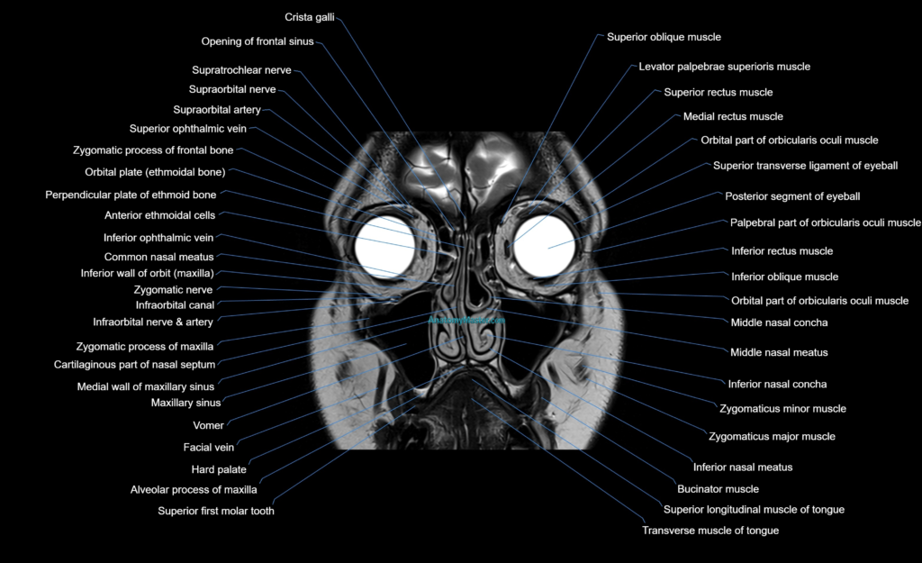 MRI face & paranasal sinuses(PNS) labelled coronal cross sectional anatomy 3T radiology image