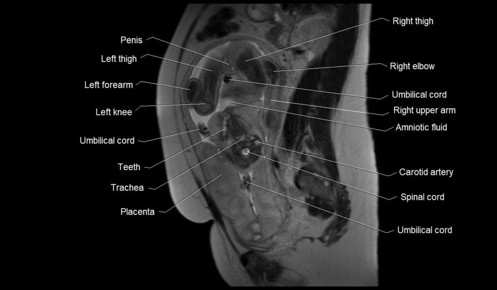 MRI fetal anatomy sagittal image