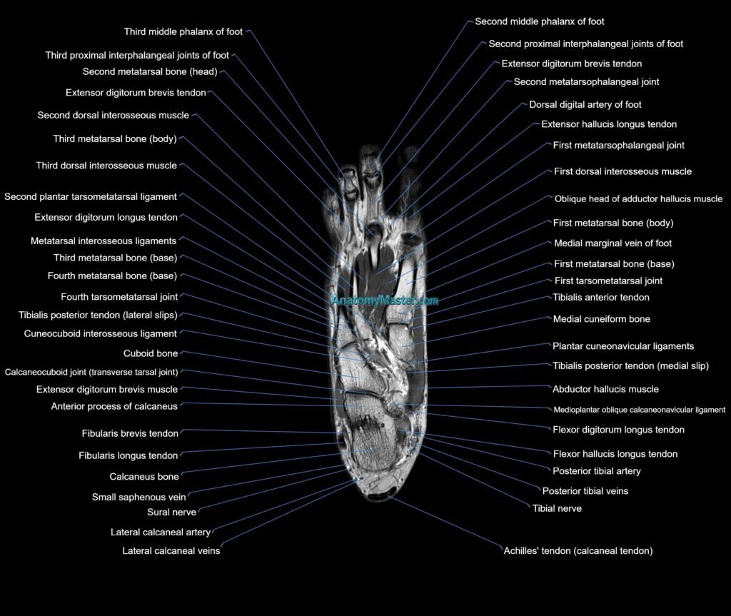 MRI foot coronal cross sectional anatomy 3T radiology image