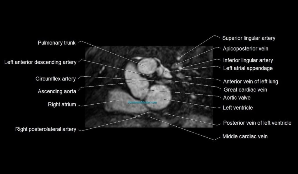 MRI heart and coronary arteries short axis anatomy image