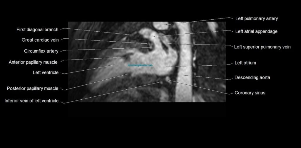 MRI heart and coronary arteries two chamber(sagittal) anatomy image