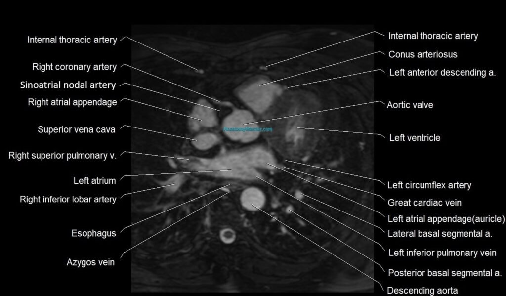 MRI heart coronary arteries and coronary veins anatomy axial image