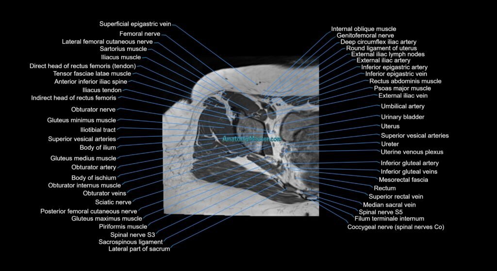 MRI hip axial cross sectional anatomy 3T 3D radiology anatomy image