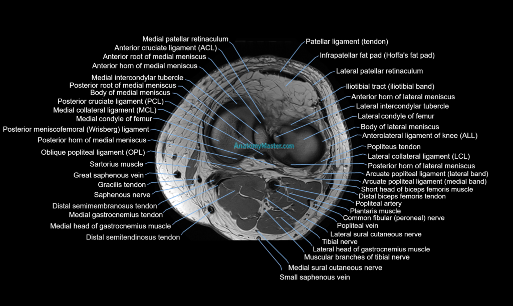 MRI knee axial cross sectional anatomy 3T radiology image
