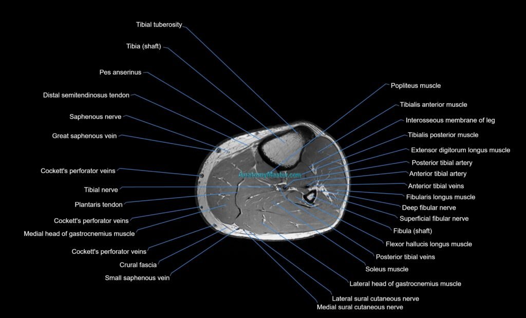MRI lower leg axial cross sectional anatomy 3T radiology image