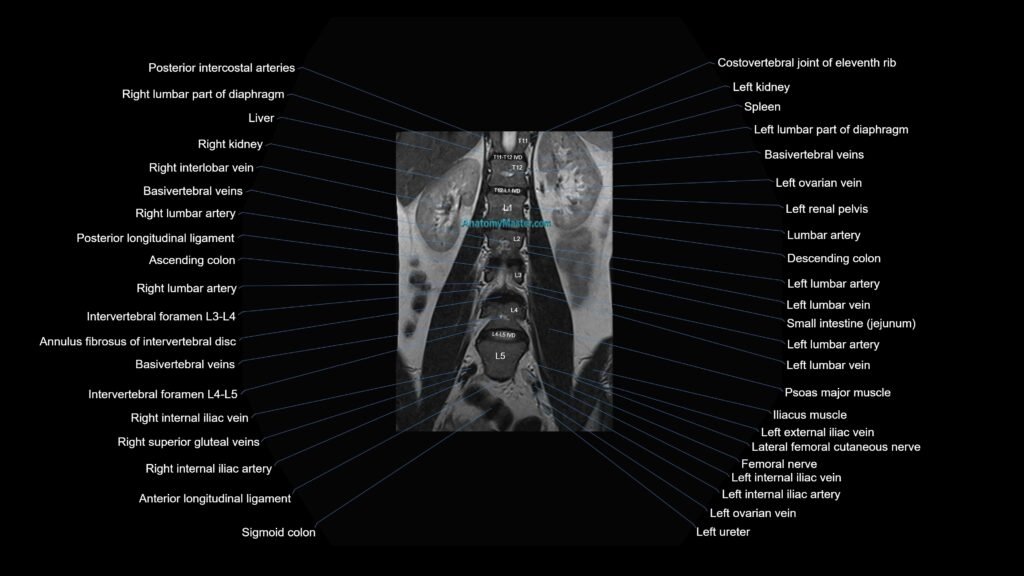 MRI lumbar spine coronal cross sectional anatomy 3T radiology image