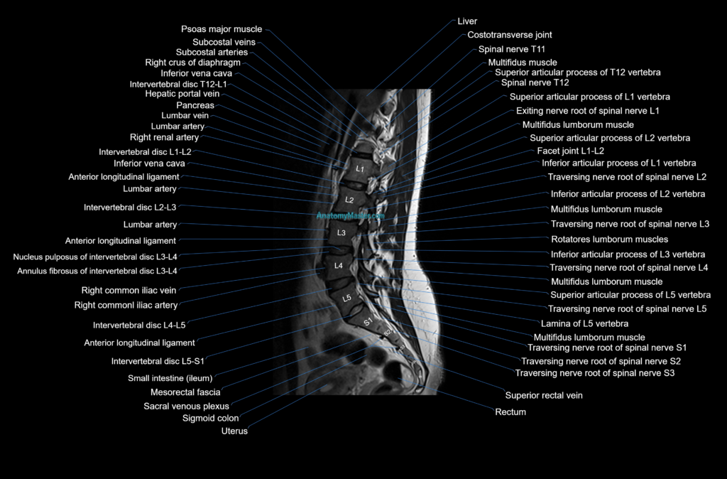 MRI lumbar spine sagittal cross sectional anatomy 3T radiology image